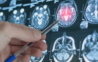Cerebral Palsy Causes and Medical Negligence
