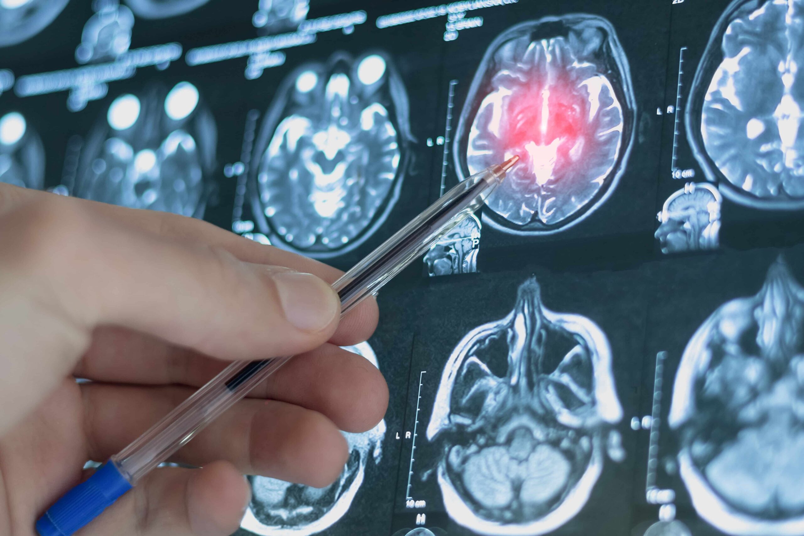 Cerebral Palsy Causes and Medical Negligence